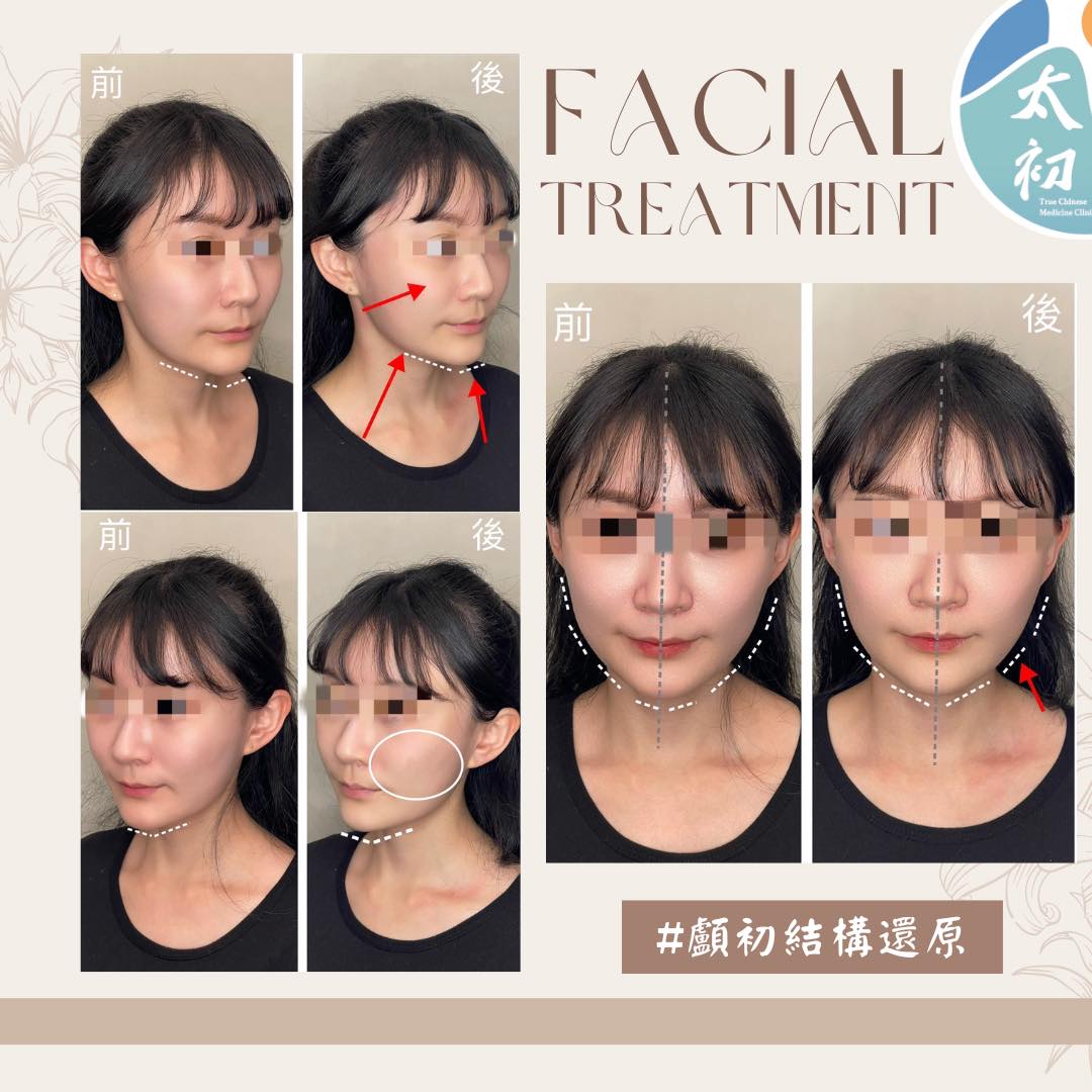 #輪廓線 #下巴歪斜 #顱初結構還原