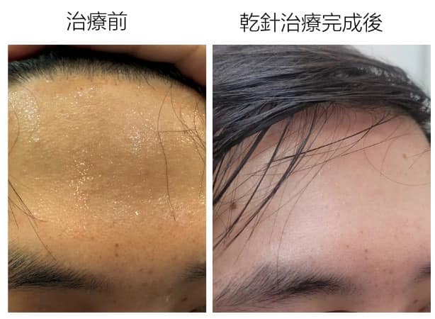 #蛋頭汗出🧑‍🦲