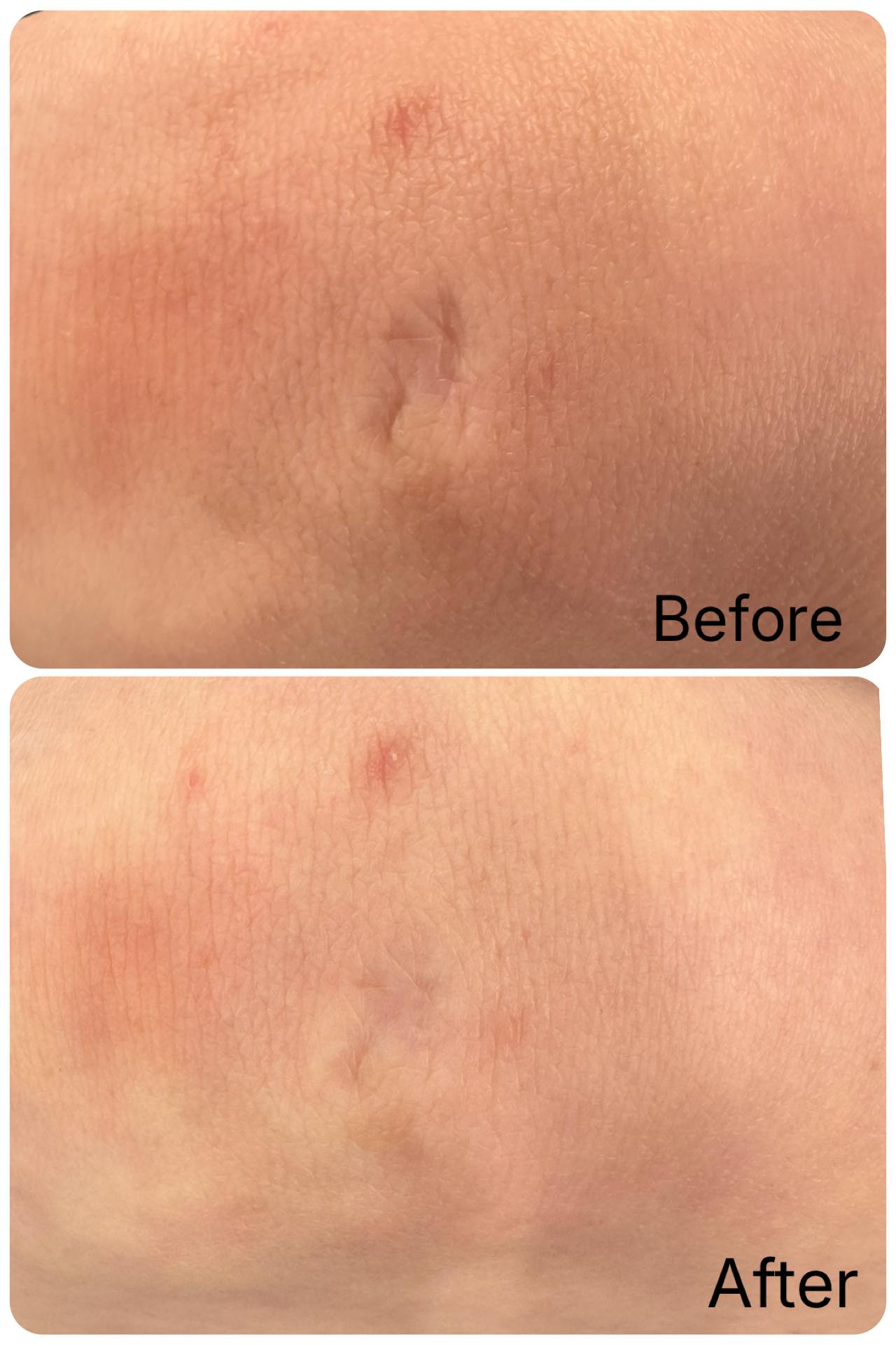 Scar work Day2