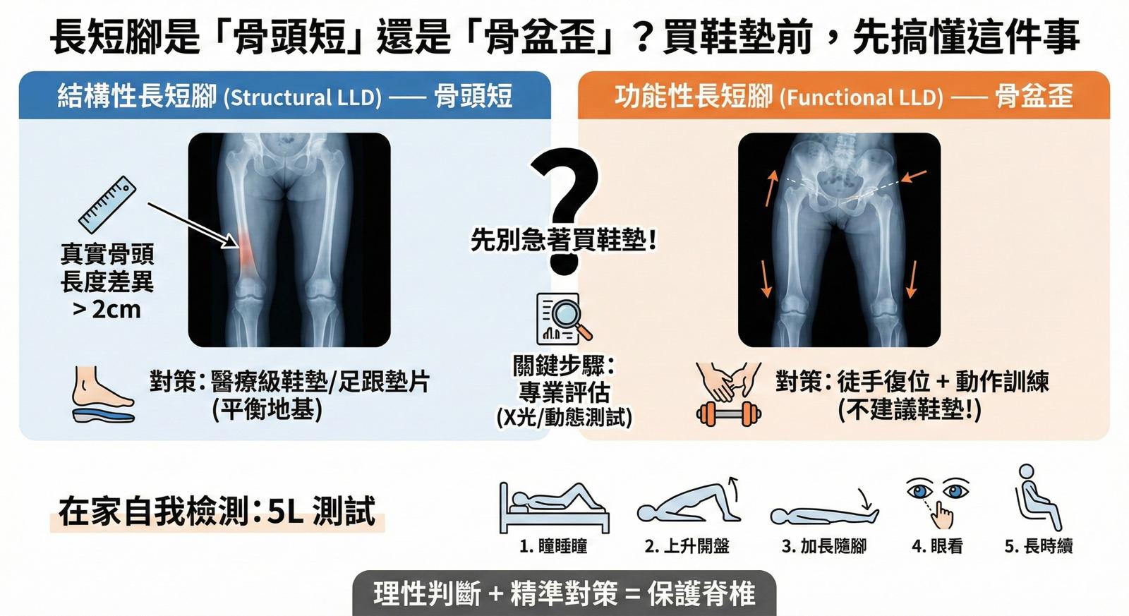 長短腳是「骨頭短」還是「骨盆歪」？買鞋墊前，先搞懂這件事