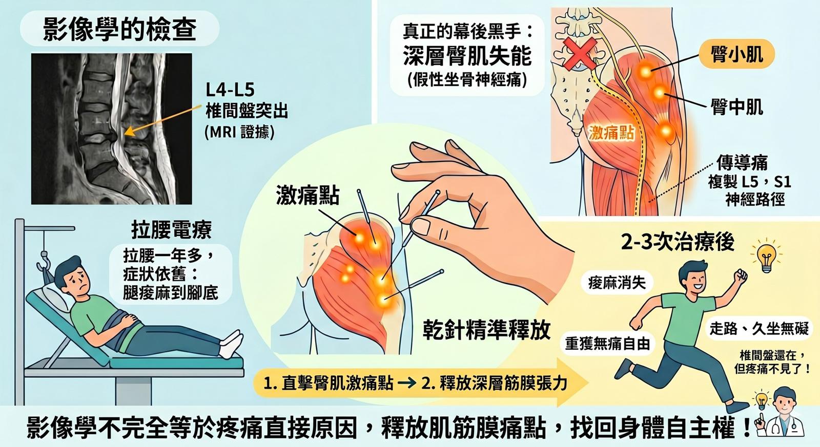 影像學MRI 確診椎間盤突出，但拉腰一年卻沒好？揪出「假性坐骨神經痛」的幕後黑手